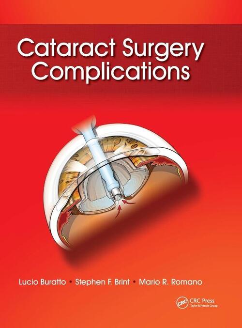 Cataract Surgery Complications